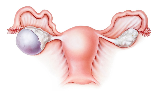 Pierdeți în greutate chist ovarian, Dieta dupa laparoscopie Pagina 2
