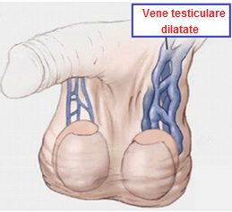 varice testicular
