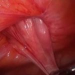 Hernia ombilicala - aspect intraoperator laparoscopic